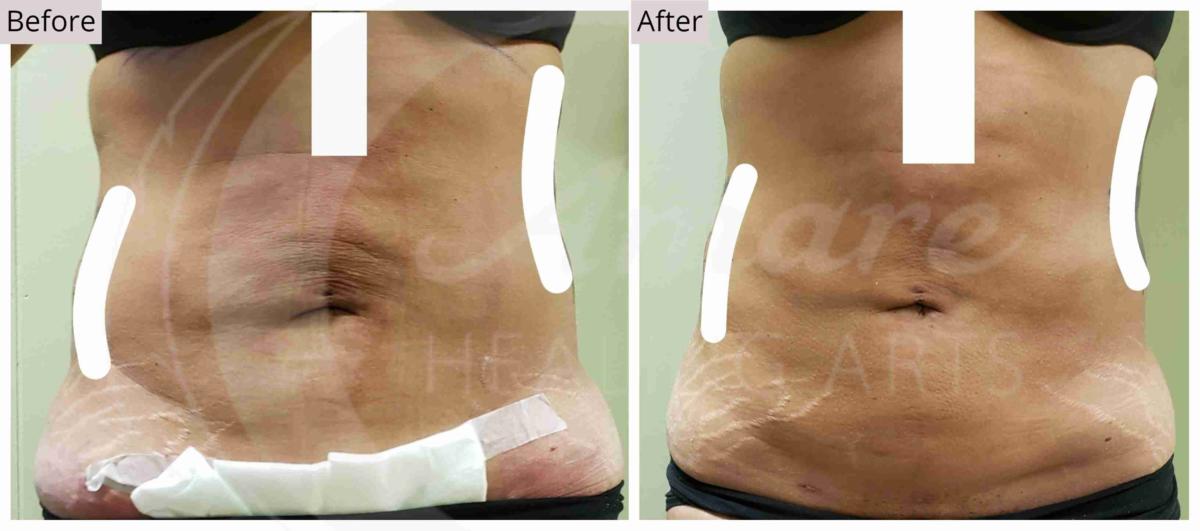 Lymphatic Drainage Plastic Surgery- Results for Post Plastic Surgery