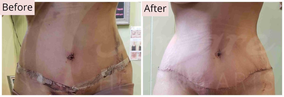 Lymphatic Drainage Plastic Surgery- Results for Post Plastic Surgery